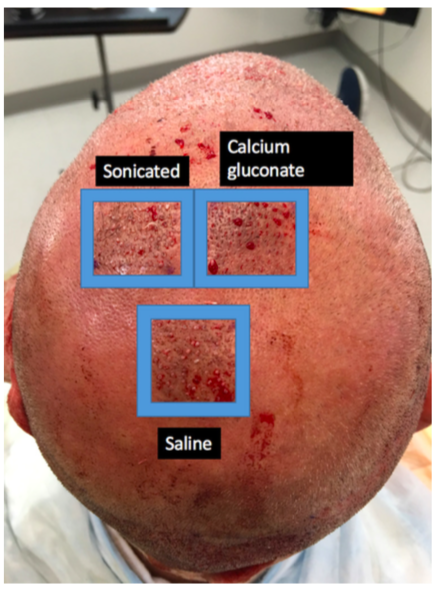 PRP合併植髮對於雄性禿患者的治療研究